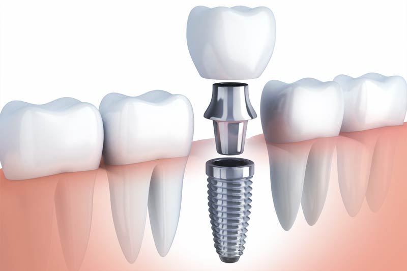 Implants Dentist in Honolulu