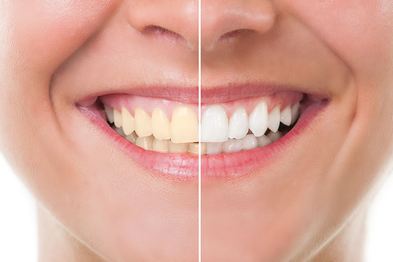 Teeth Whitening in Honolulu